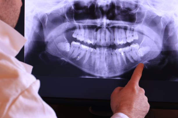 Best Emergency Wisdom Tooth Extraction in Lodi, OH