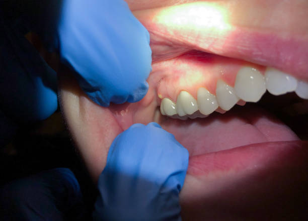 Best Dental Abscess Treatment in Lodi, OH